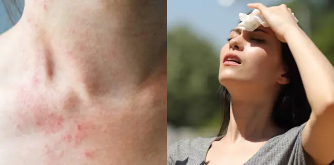 വേനൽകാലത്ത് ചൂടുകുരു മാറാൻ പൗഡറിനെ ആശ്രയിക്കേണ്ട, ഇക്കാര്യങ്ങൾ ശ്രദ്ധിച്ചാൽ മാത്രം മതി