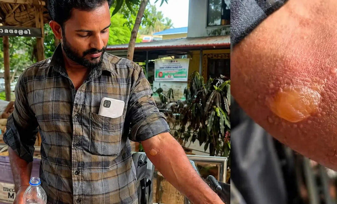 താമരശ്ശേരിയിൽ യുവാവിന് സൂര്യാതപം; ശരീരത്തിൽ പല ഭാഗങ്ങളിലും പൊള്ളലേറ്റു, ഉന്നതതല യോഗം ഇന്ന്